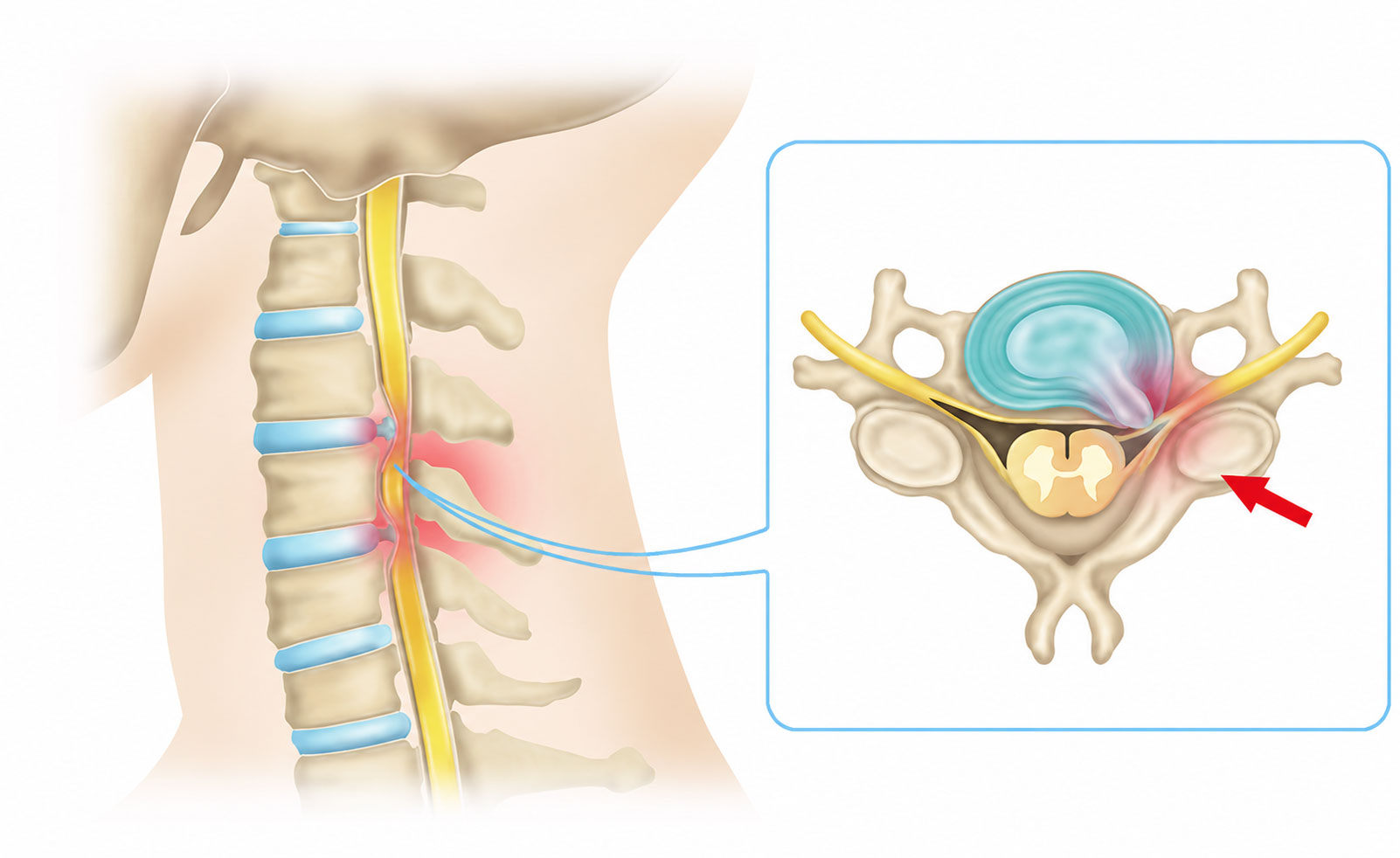 목디스크 경추 추간판 신경근 해부 구조 — 대구목디스크병원 연세마디신경외과