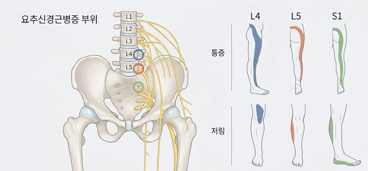 요추 신경근 다리저림 방향 데르마톰 L4 L5 S1 — 대구허리디스크 연세마디신경외과