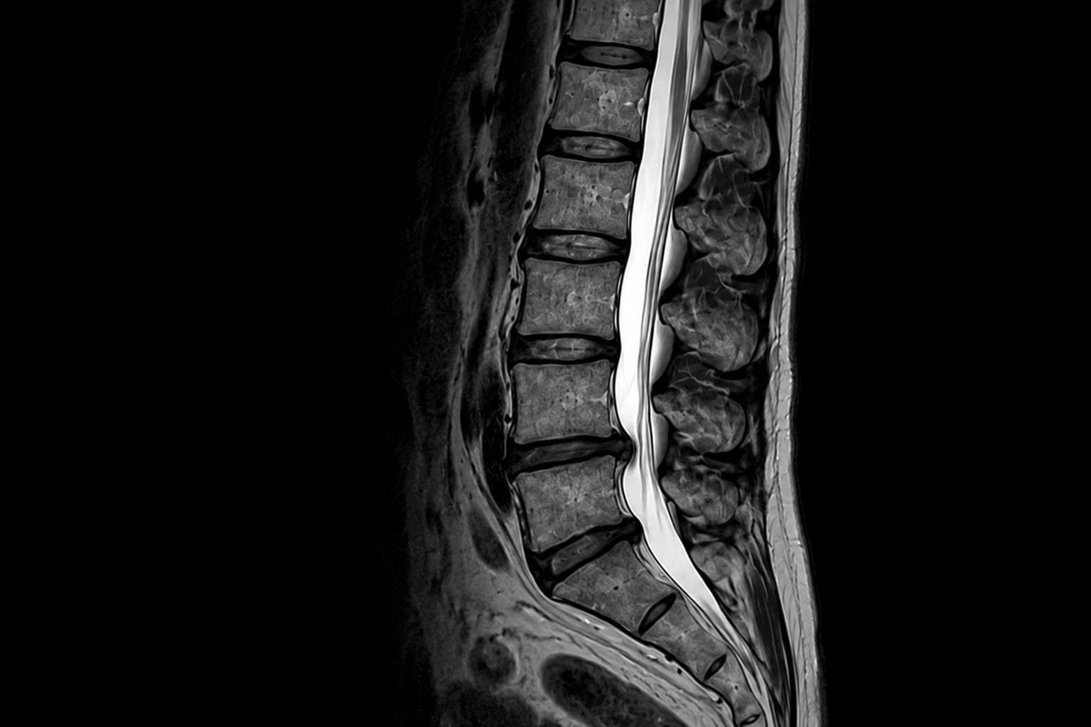 허리디스크 MRI 정밀 진단 대구허리주사병원 연세마디신경외과