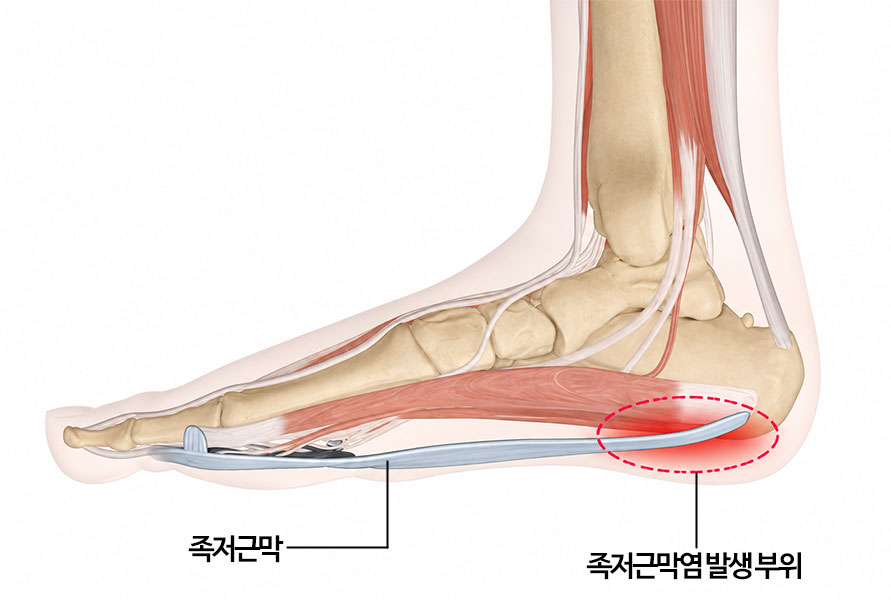 족저근막 해부 구조 발뒤꿈치 종골 아치 — 대구족저근막염 연세마디신경외과