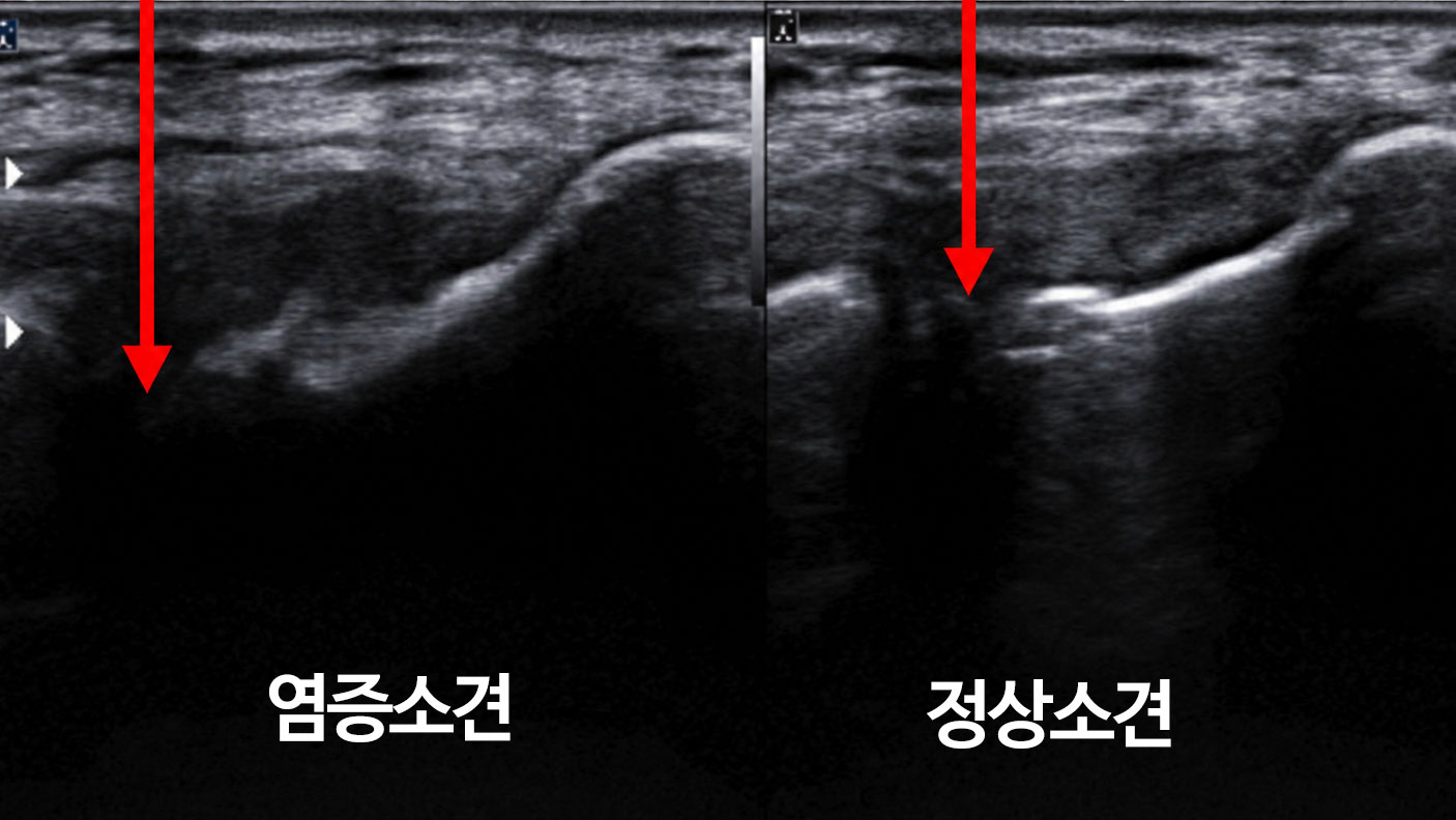 테니스엘보 초음파 힘줄 부착부 두꺼워짐 부분 파열 — 대구테니스엘보병원 연세마디신경외과
